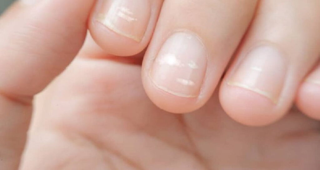 Le unghie parlano di noi: cosa rivelano sulla tua salute